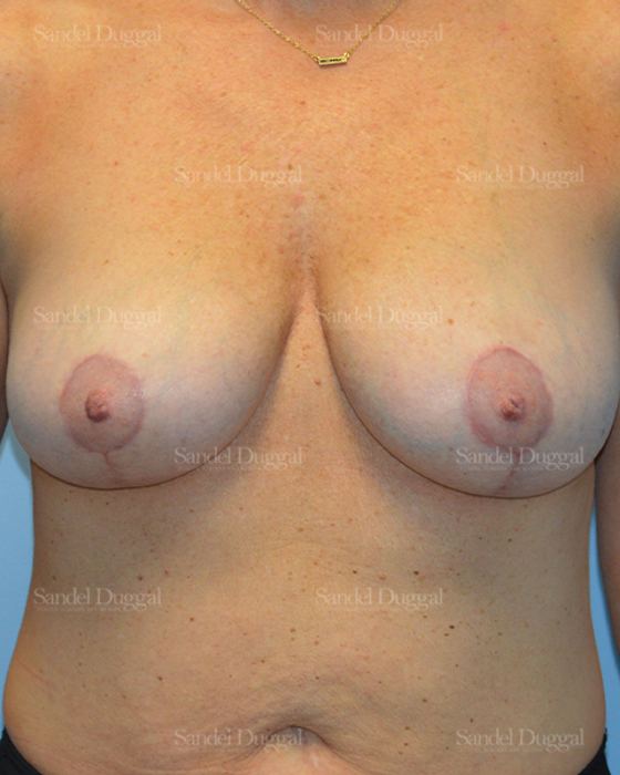 Breast Augmentation with Lift after, case 3442