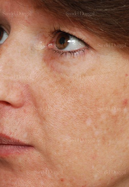 Laser Skin Resurfacing before, case 2986
