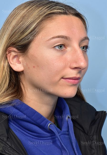 Rhinoplasty before, case 5375