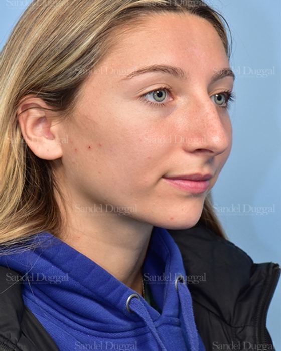 Rhinoplasty before, case 5375