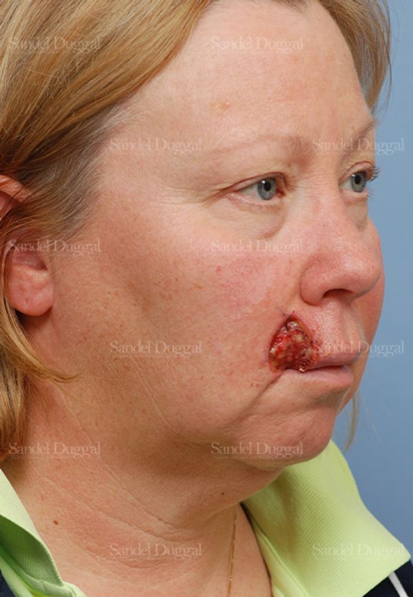 Reconstruction after Mohs before, case 2772