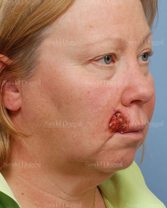 Reconstruction after Mohs before, case 2772