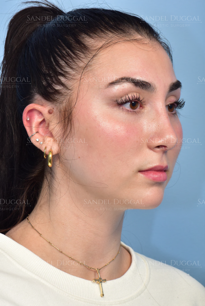 Rhinoplasty after, case 6002