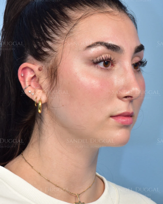 Rhinoplasty after, case 6002