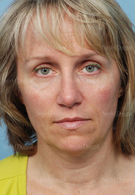 Rhinoplasty after, case 2855