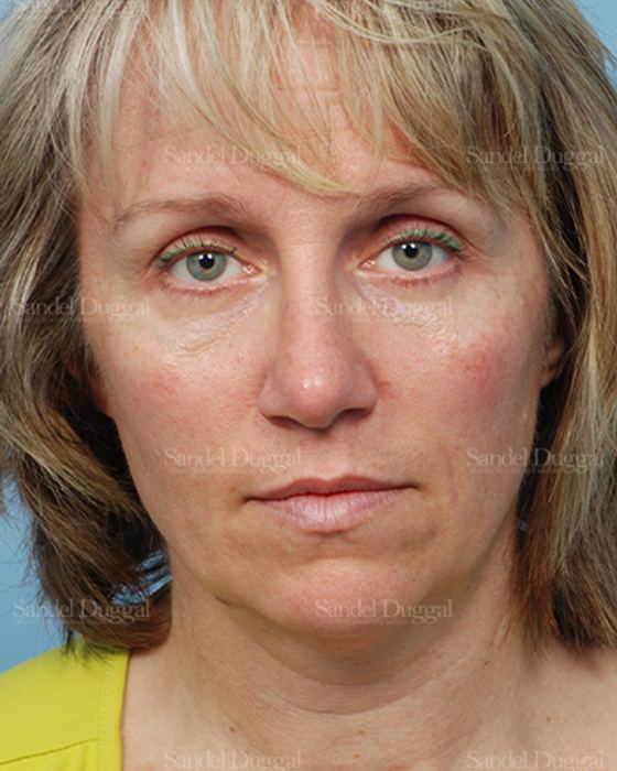 Rhinoplasty after, case 2855