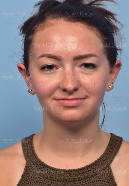 Otoplasty after, case 4073