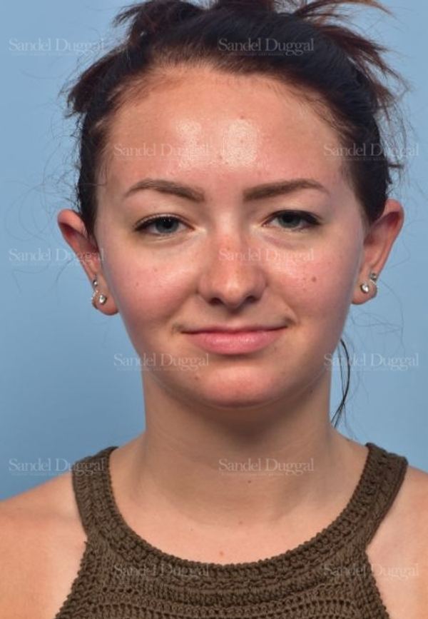 Otoplasty after, case 4073