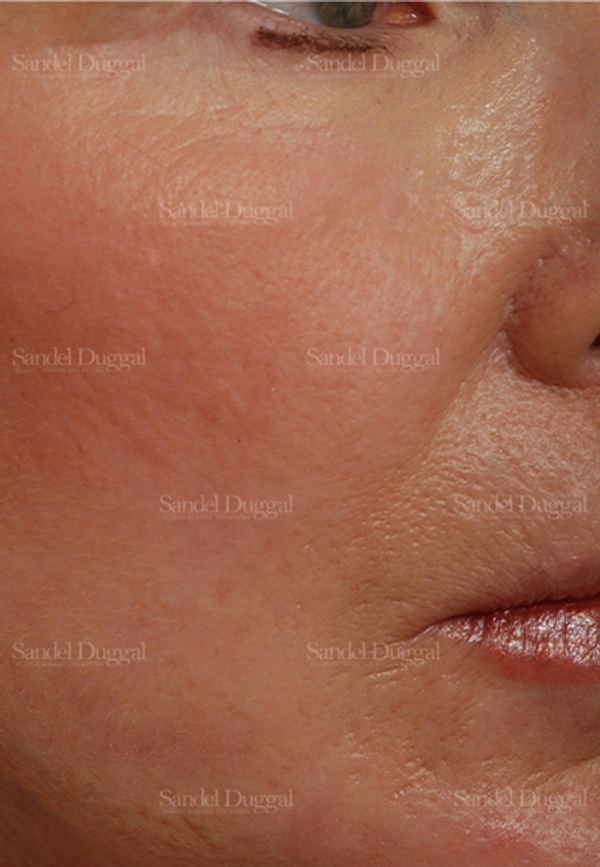 Laser Skin Resurfacing after, case 2929