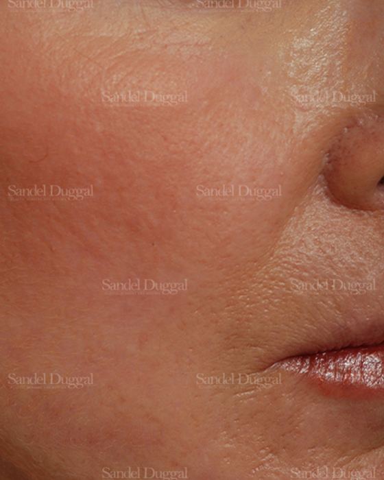 Laser Skin Resurfacing after, case 2929