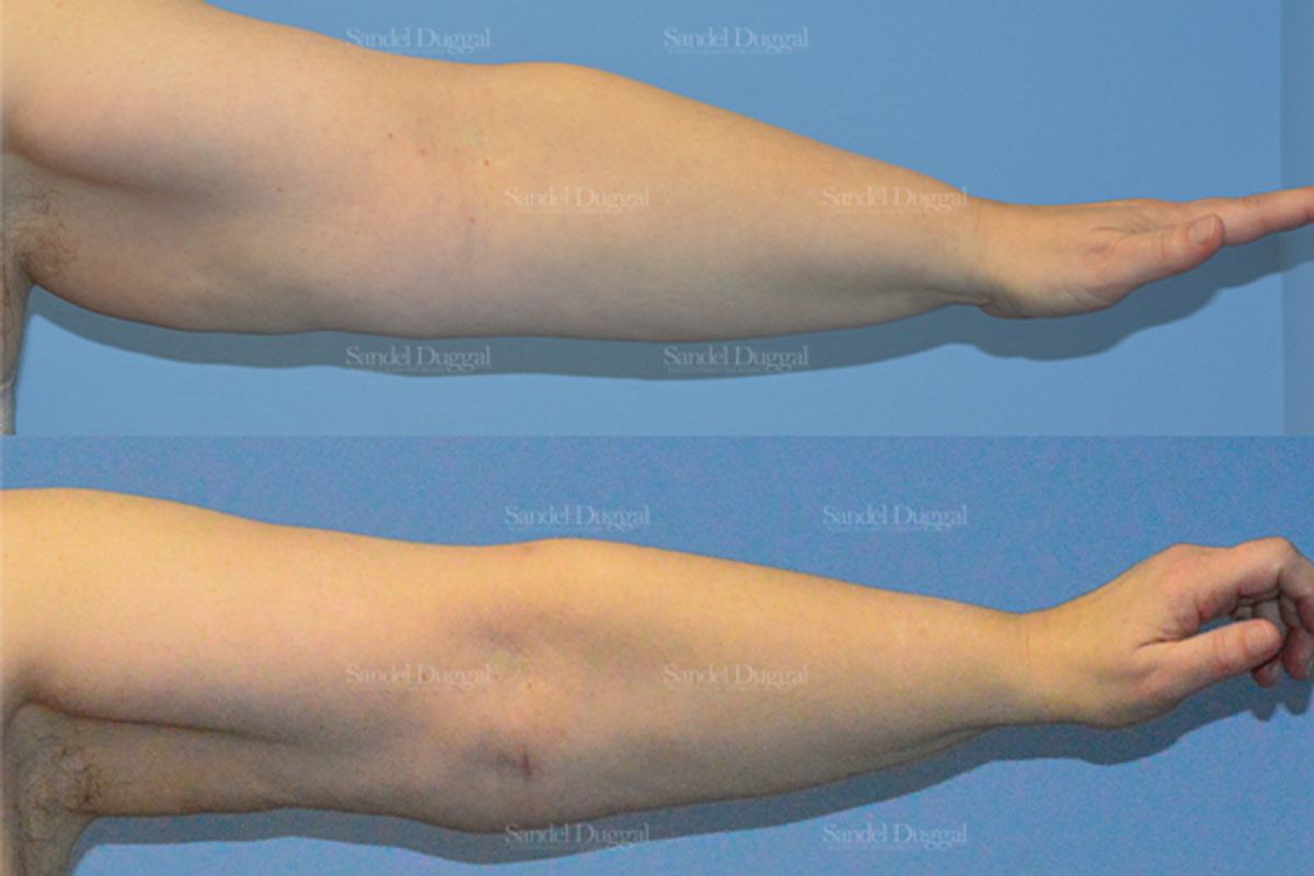 Liposuction — Arms before and after, case 2485