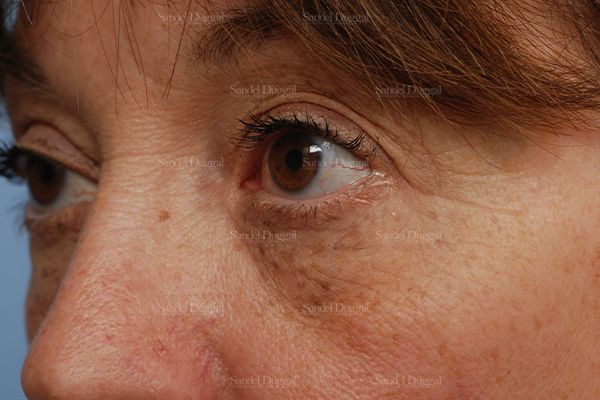 Eyelid Rejuvenation before, case 831