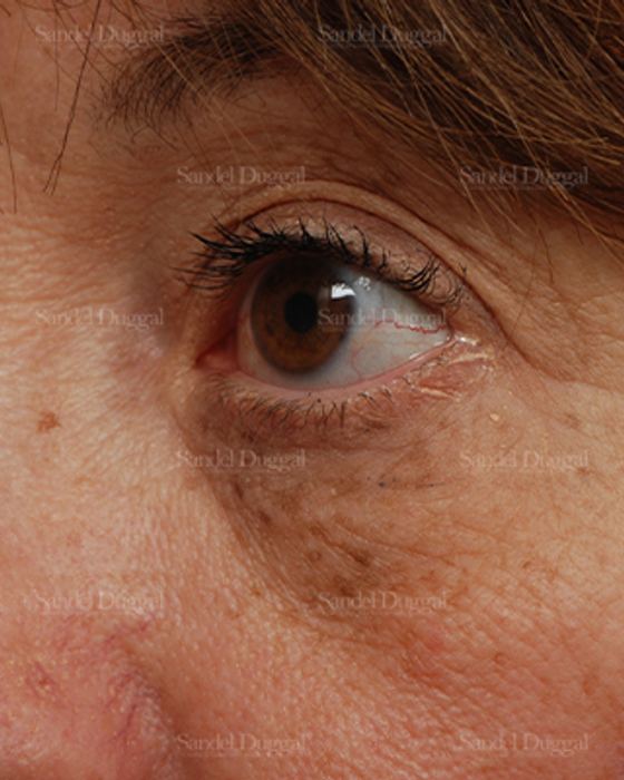 Eyelid Rejuvenation before, case 831