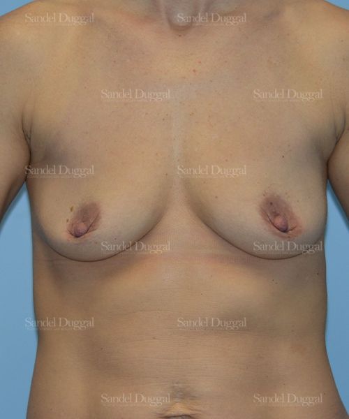 Breast Augmentation with Lift before, case 3421
