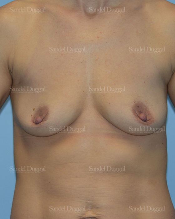 Breast Augmentation with Lift before, case 3421