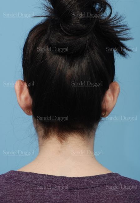 Otoplasty before, case 4078