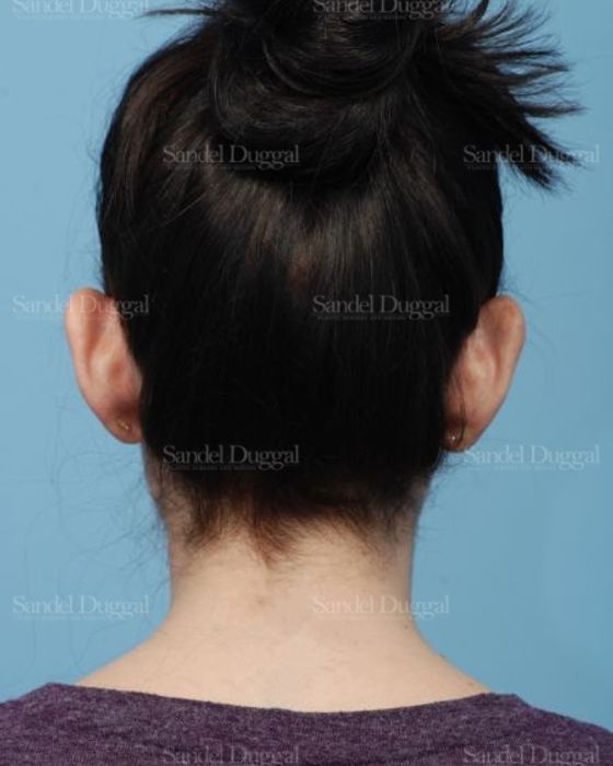 Otoplasty before, case 4078