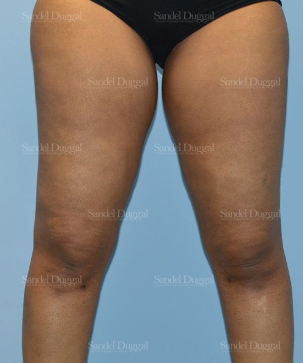 Liposuction — Legs & Flanks after, case 2537