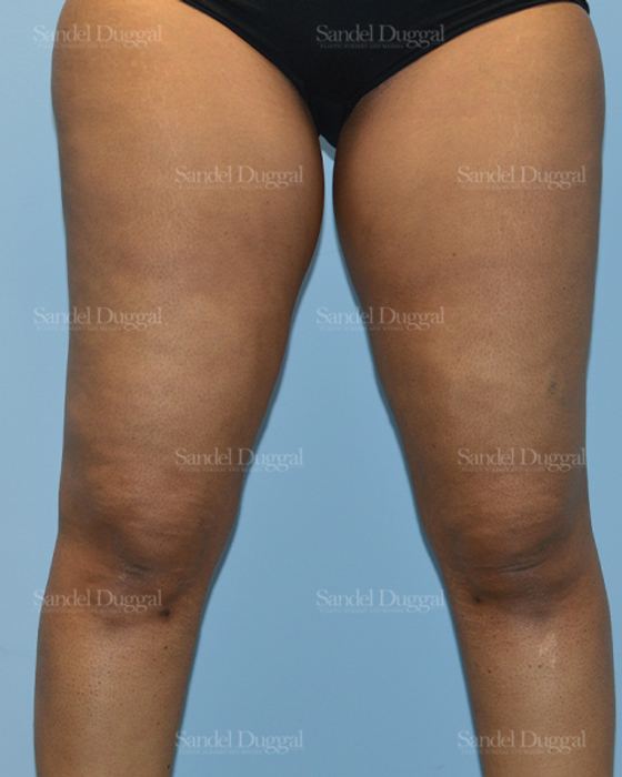 Liposuction — Legs & Flanks after, case 2537