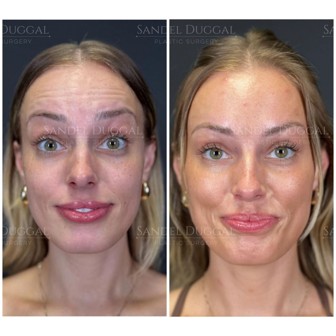 Botox & Fillers before and after, case 6012