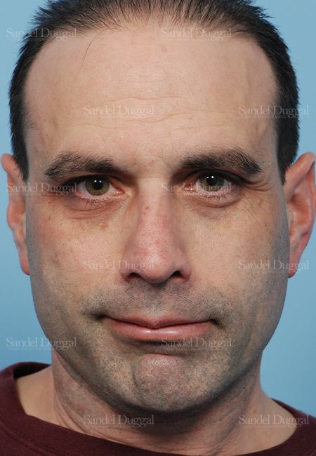 Rhinoplasty after, case 2909