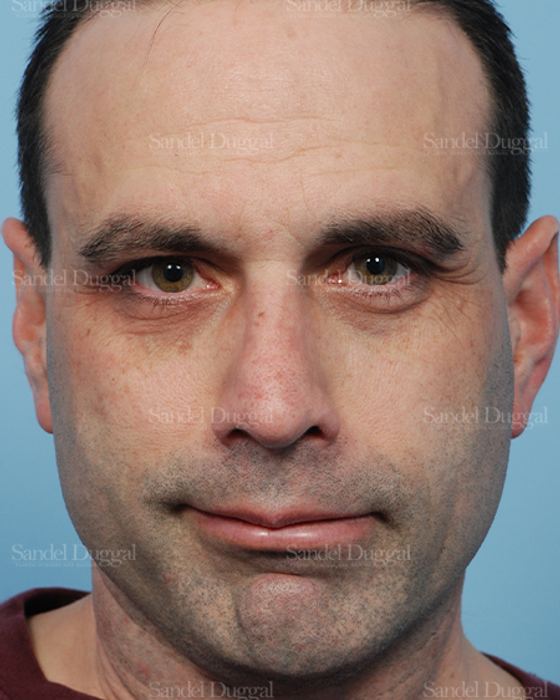 Rhinoplasty after, case 2909