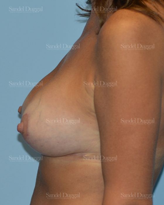 Breast Augmentation with Lift after, case 3407