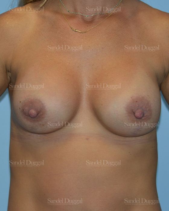 Breast Augmentation with Lift after, case 3421