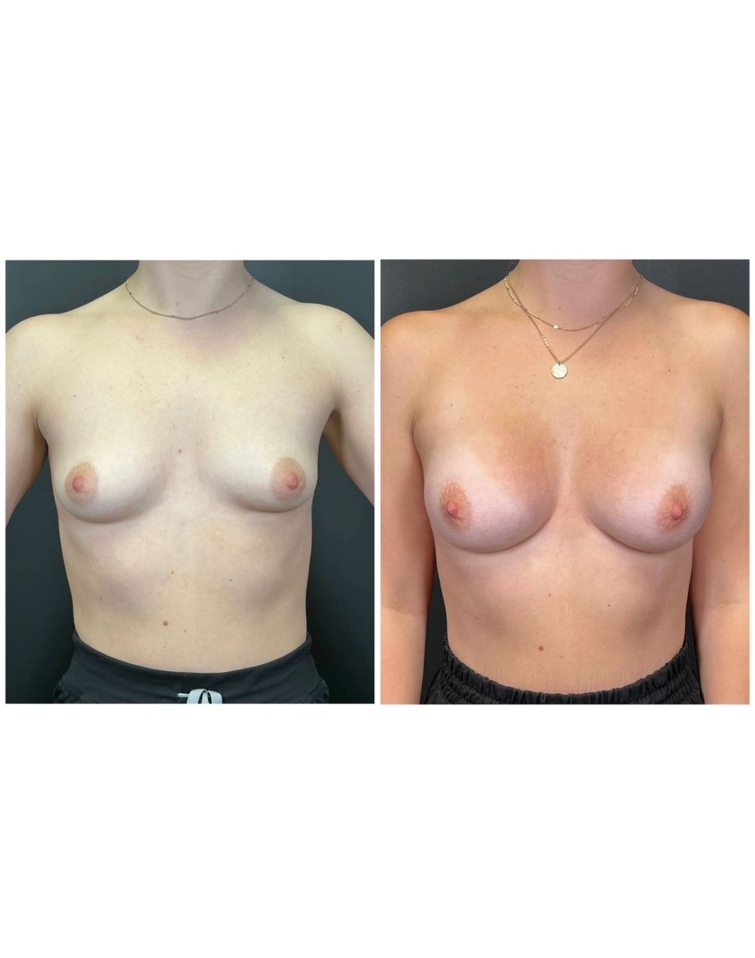 Motiva Preserve before and after, case preserve-03