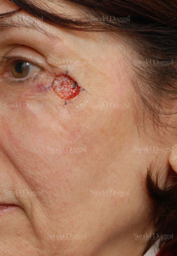 Reconstruction after Mohs before, case 2745