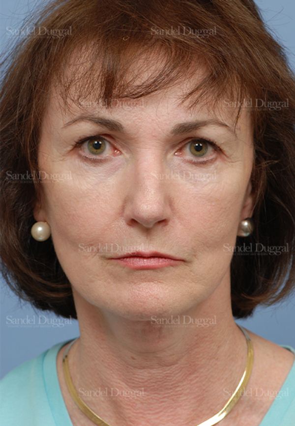 Cheek Augmentation before, case 1427