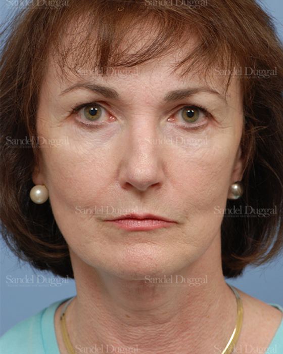 Cheek Augmentation before, case 1427
