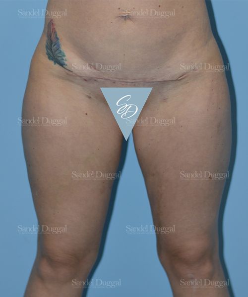 Liposuction — Legs & Flanks after, case 2532