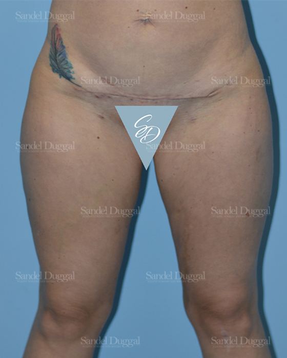 Liposuction — Legs & Flanks after, case 2532