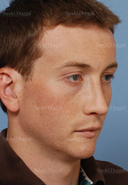Rhinoplasty after, case 2899