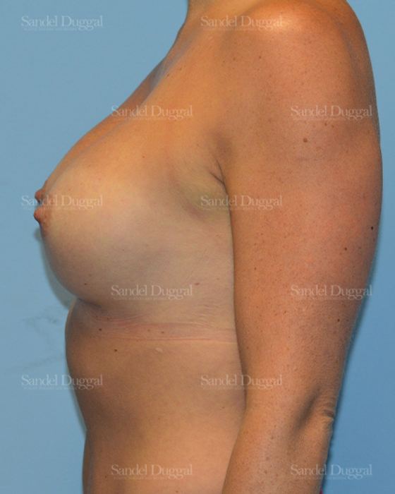 Breast Augmentation after, case 3171