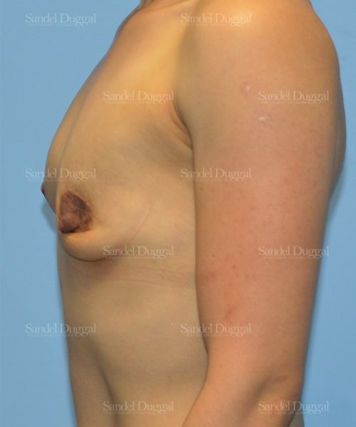 Breast Augmentation before, case 3255