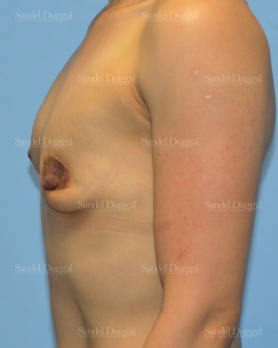 Breast Augmentation before, case 3255