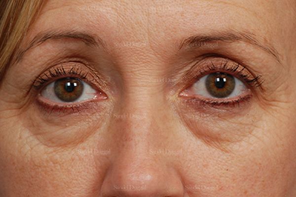Eyelid Rejuvenation before, case 1917