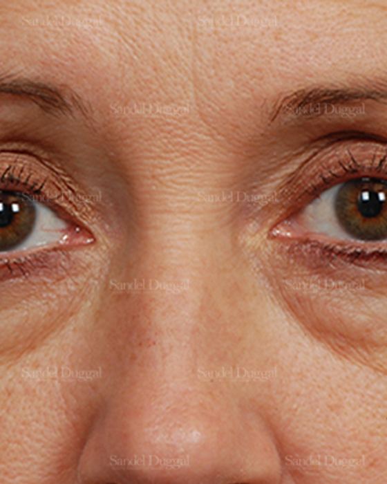 Eyelid Rejuvenation before, case 1917