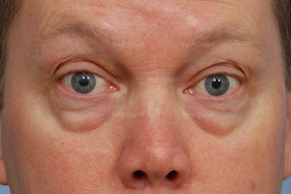 Eyelid Rejuvenation before, case 1965