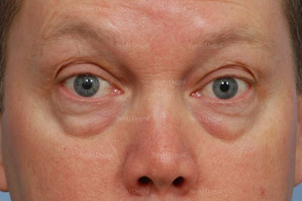 Eyelid Rejuvenation before, case 1965