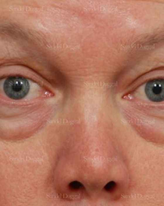 Eyelid Rejuvenation before, case 1965