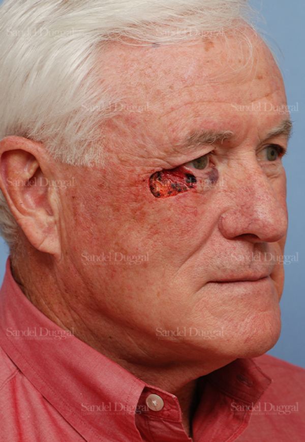 Reconstruction after Mohs before, case 2742