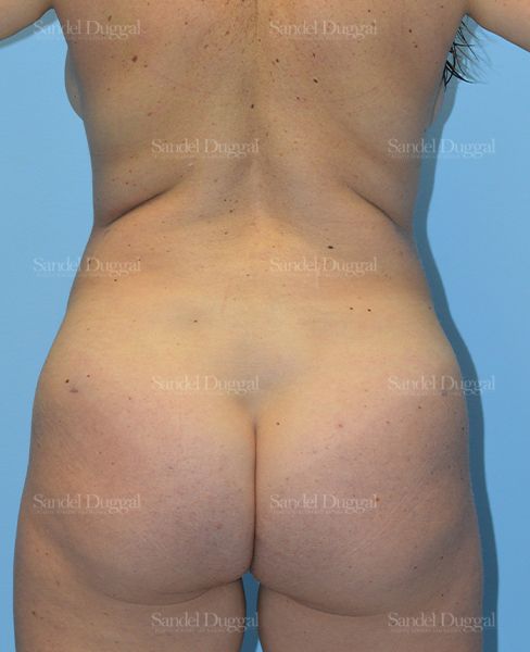 Liposuction — Legs & Flanks after, case 2529