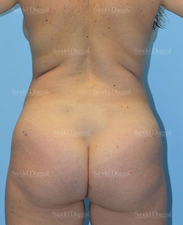 Liposuction — Legs & Flanks after, case 2529