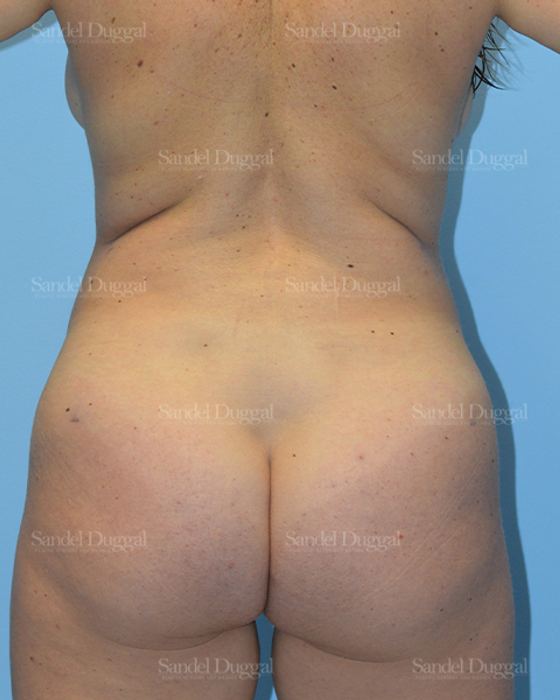 Liposuction — Legs & Flanks after, case 2529