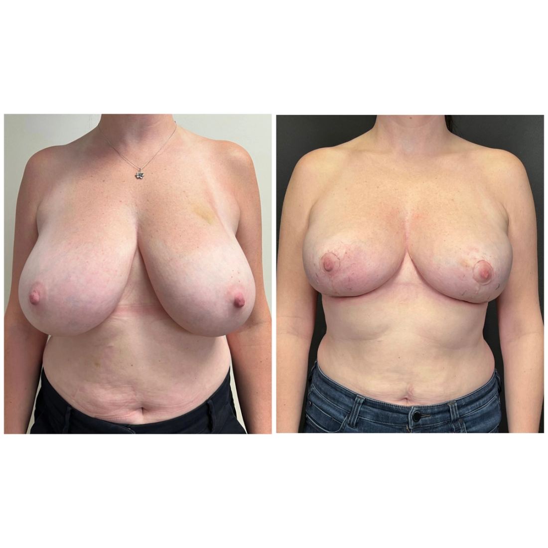 Breast Lift before and after, case breast-lift-new-05
