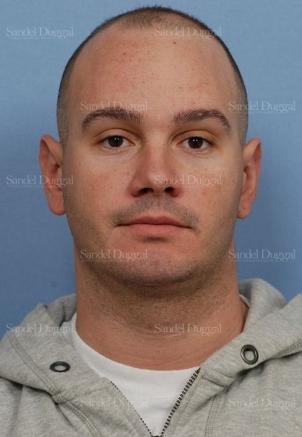 Otoplasty after, case 4068