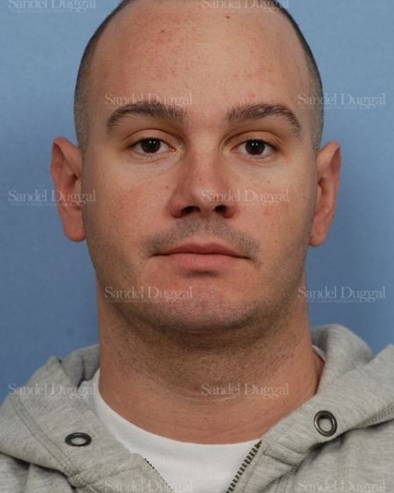 Otoplasty after, case 4068